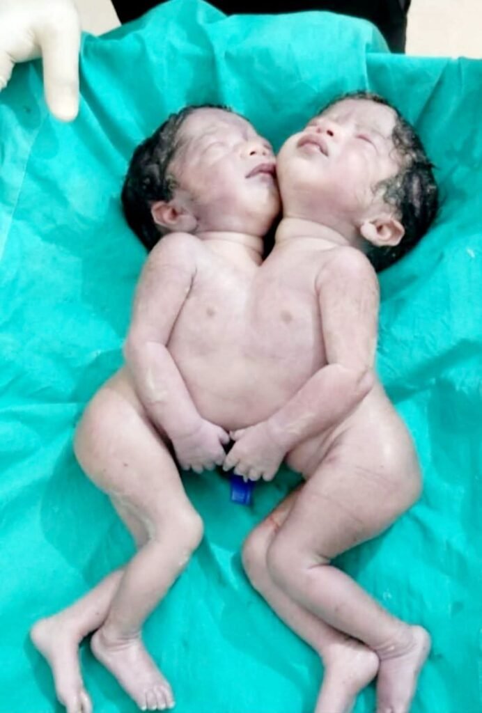 महराजगंज जुड़वां बच्चे